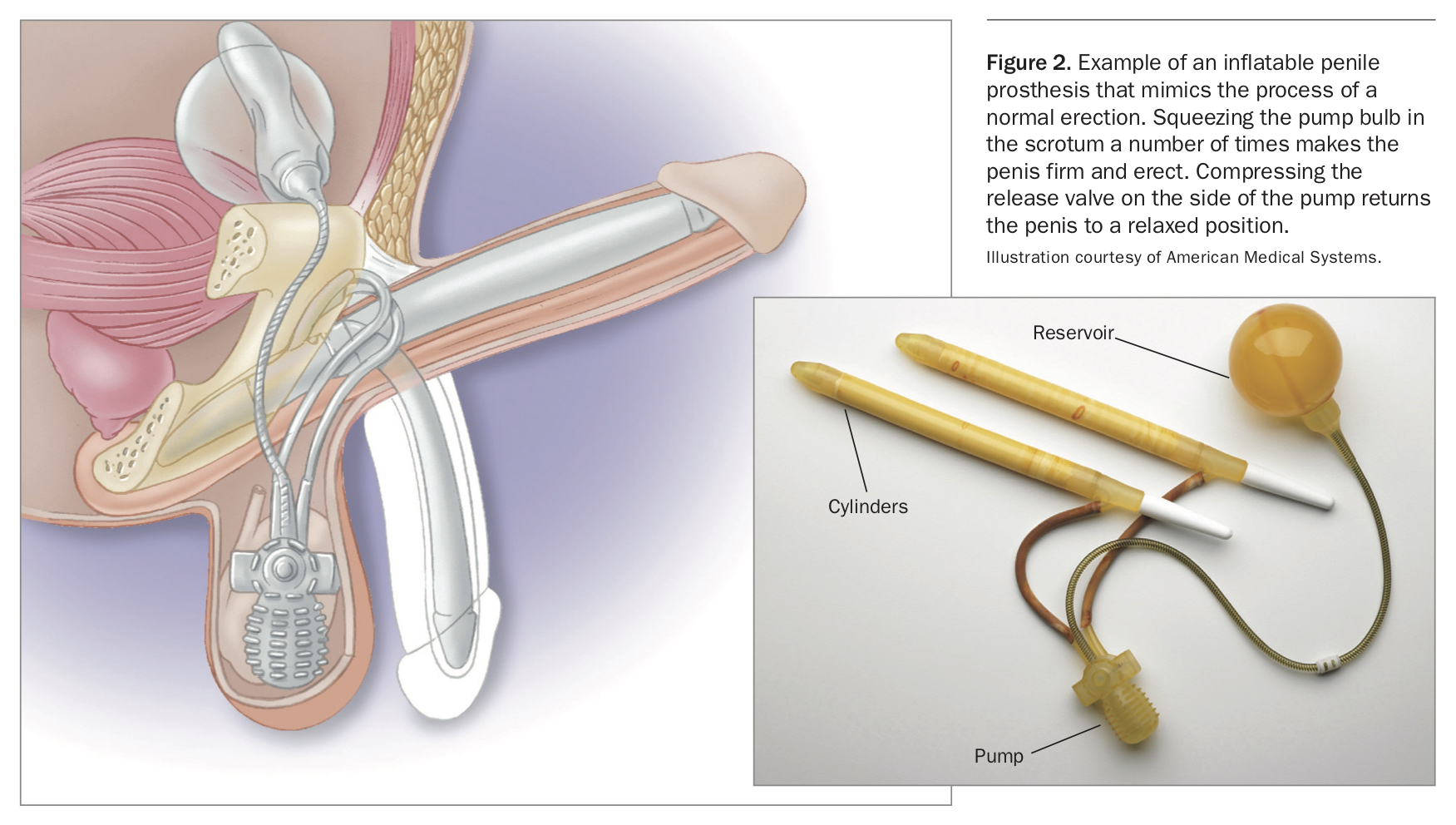 Erectile dysfunction. Part 2 Management of ED unresponsive to